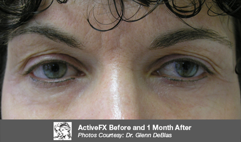 After CO2 Laser Resurfacing