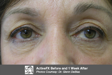After Fractional CO2 Treatment