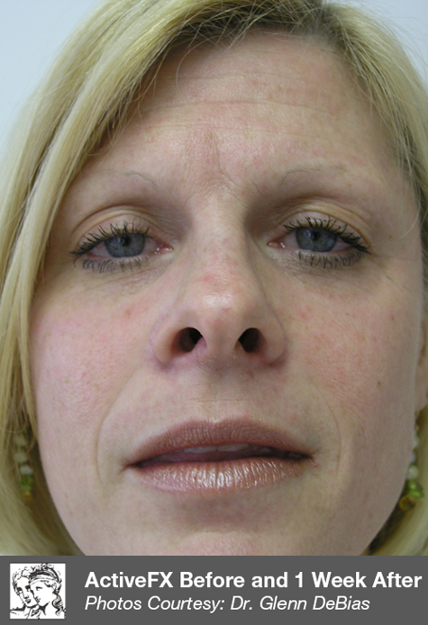 After RF Microneedling