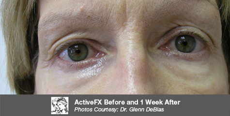 After Cosmetic Injectables