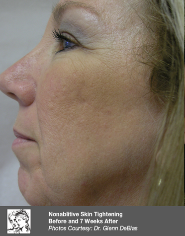After Body Contouring