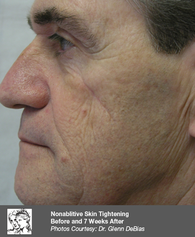 After Fat Reduction Results