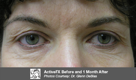 Before CO2 Laser Resurfacing