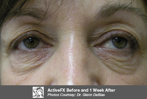 Before Fractional CO2 Treatment