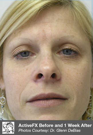 Before RF Microneedling