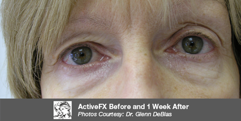 Before Cosmetic Injectables