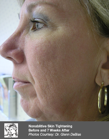 Before Body Contouring