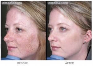 After Vein Treatments