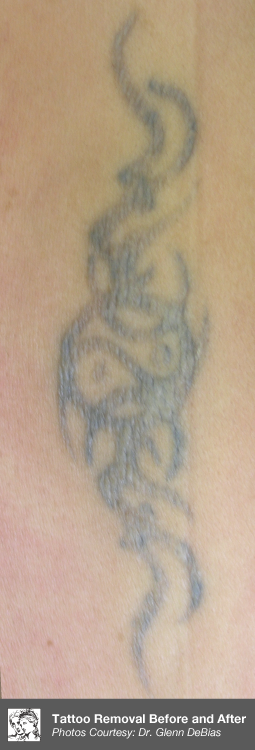 After Laser Tattoo Removal