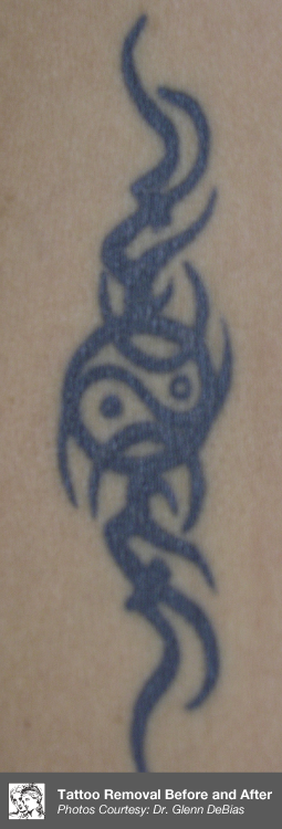 Before Laser Tattoo Removal