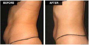 After VASERshape Body Sculpting